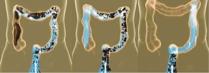 Colon Cleansing