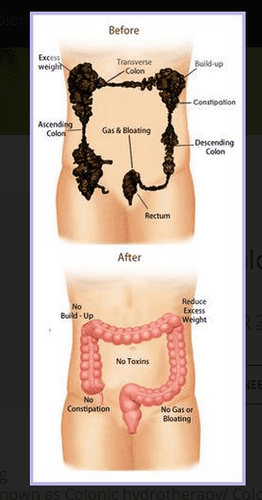Colon Cleansing Before and After