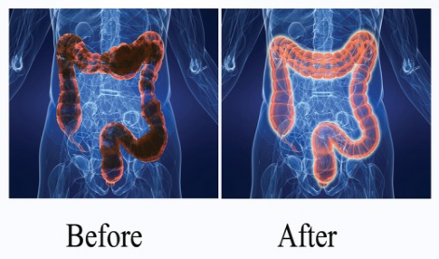 Colon Cleansing Before and After